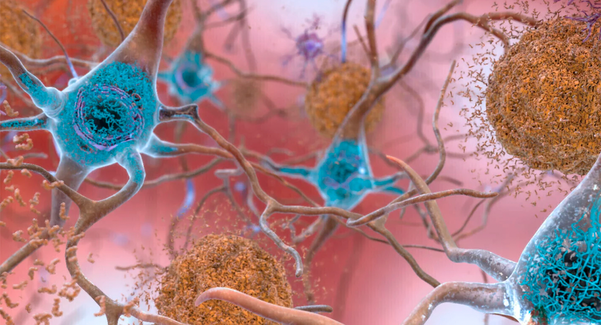 Graphic of cells in an Alzheimer's affected brain.